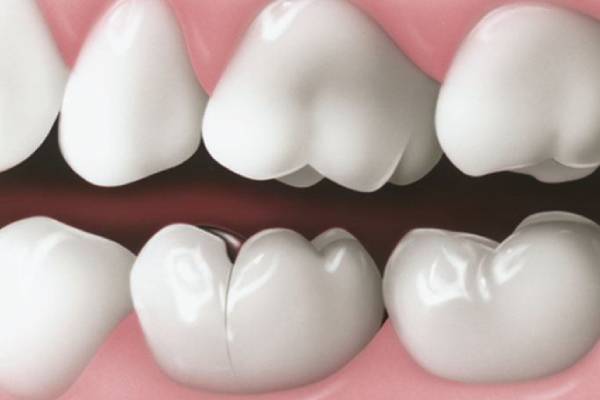 Cracked Teeth