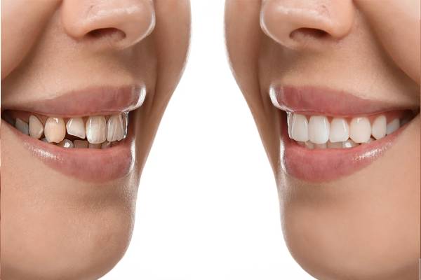 Invisalign