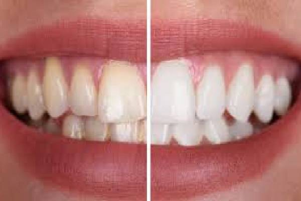 Teeth Cleaning